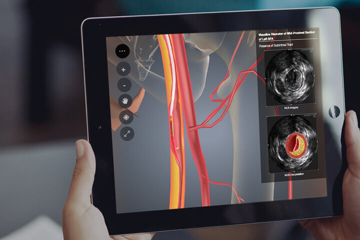 Hands holding a tablet showing a 3D anatomical view of the vascular system alongside intravascular ultrasound (IVUS) images for educational and diagnostic comparison. title=