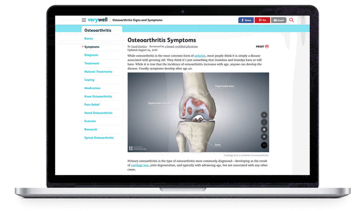 Laptop displaying a Verywell Health article on osteoarthritis symptoms with an embedded interactive 3D model of a knee joint highlighting cartilage and bone degeneration. title=